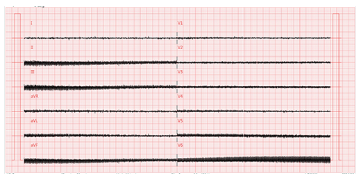The balance test results of the CMRR 3.0+ and the ECG without a metal sheet The balance test results of the CMRR 3.0+ and the ECG without a metal sheet