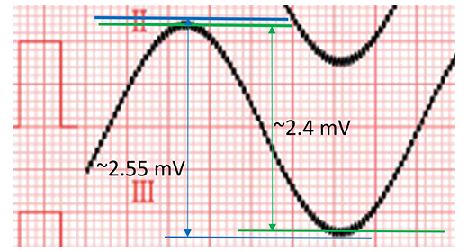 The ambient 60Hz noise is introduced by adding a 620kΩ/4.7nF parallel circuit, the average value of the upper and lower noise levels need to be calculated before calculating the Vpp value The ambient 60Hz noise is introduced by adding a 620kΩ/4.7nF parallel circuit, the average value of the upper and lower noise levels need to be calculated before calculating the Vpp value