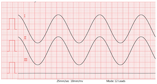 Lead II waveform (without 620kΩ/4.7nF) Lead II waveform (without 620kΩ/4.7nF)