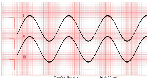 Lead II waveform (with 620kΩ/4.7nF and 300mV DC) Lead II waveform (with 620kΩ/4.7nF and 300mV DC)