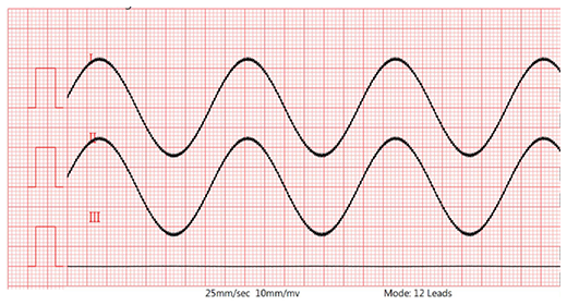 Lead II waveform (with 620kΩ/4.7nF and -300mV DC) Lead II waveform (with 620kΩ/4.7nF and -300mV DC)
