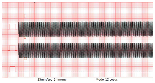 Lead II waveform (40Hz, without 620kΩ/4.7nF) Lead II waveform (40Hz, without 620kΩ/4.7nF)