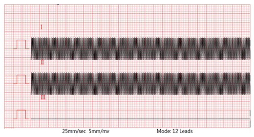 Lead II waveform (40Hz, with 620kΩ/4.7nF and 300mV DC) Lead II waveform (40Hz, with 620kΩ/4.7nF and 300mV DC)
