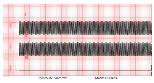 Lead II waveform (40Hz, with 620kΩ/4.7nF and -300mV DC) Lead II waveform (40Hz, with 620kΩ/4.7nF and -300mV DC)
